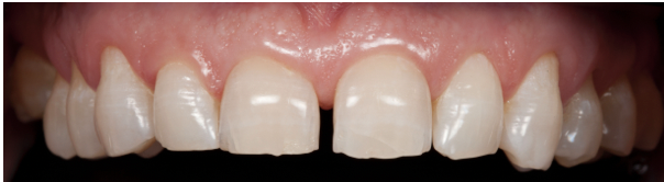 Dentadura tras Blanqueamiento, Clínica Dental Oral D.sign